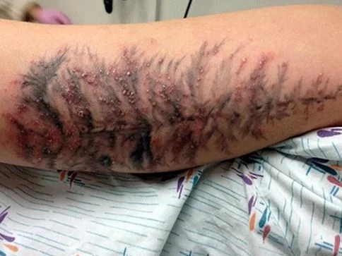 Dị ứng mực xăm